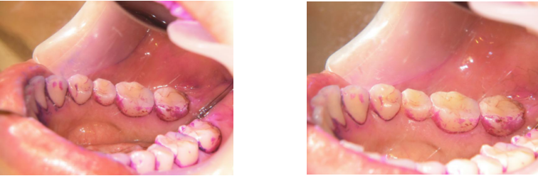 噂のくわえるだけのマウスピース型電動歯ブラシを使ってみた 神谷町デンタルクリニック